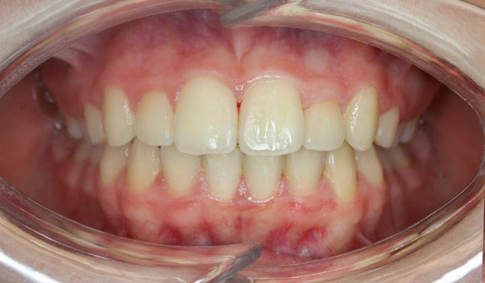 Trio-Dental-Lingual-braces-After02
