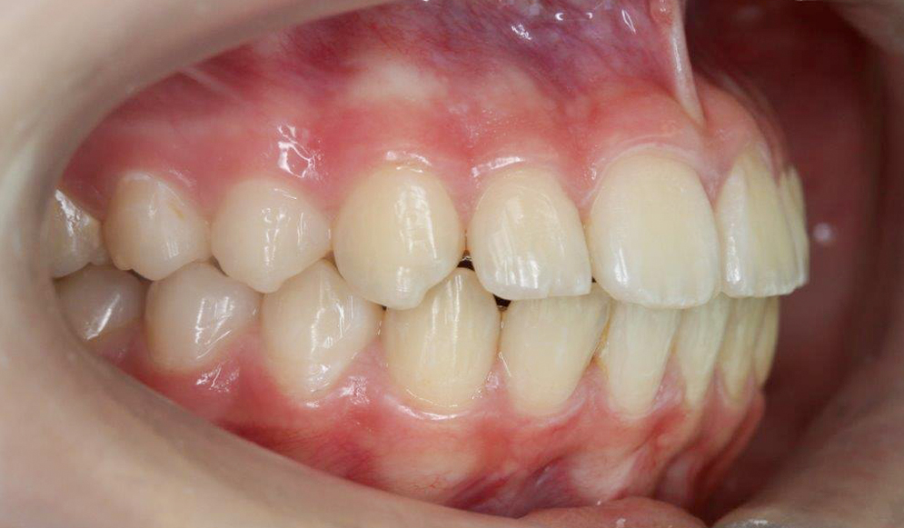 Trio-Dental-Lingual-braces-After03