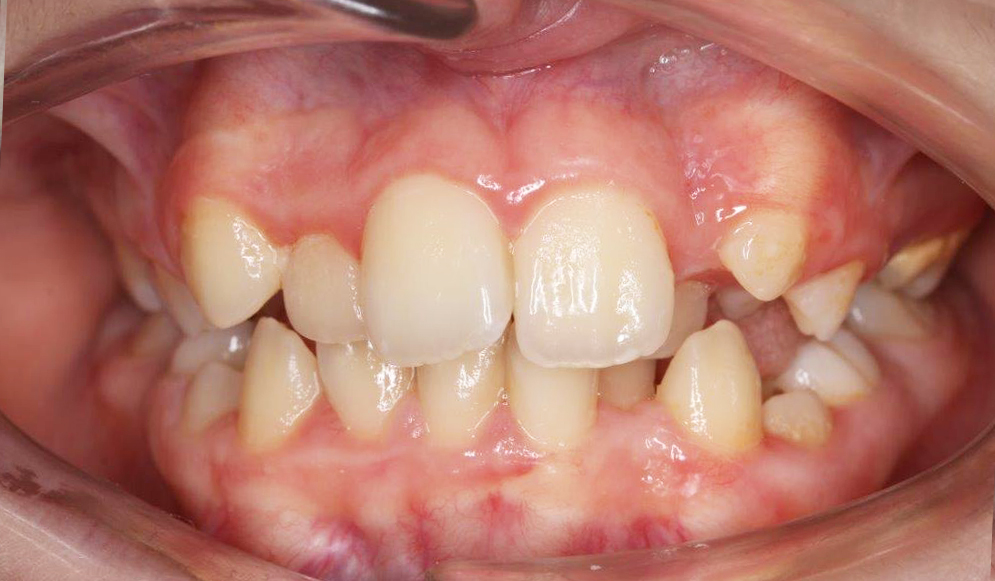 Trio-Dental-Lingual-braces-Before02