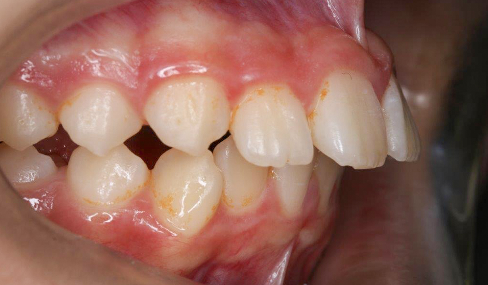 Trio-Dental-Lingual-braces-Before03