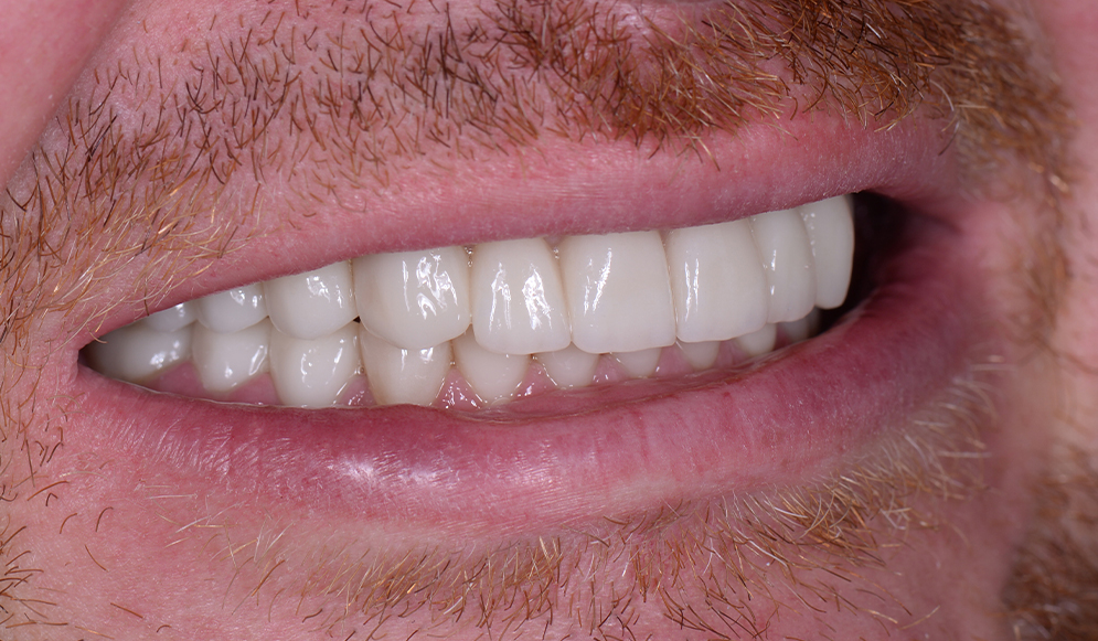 Trio-Dental-Center-After-implants01
