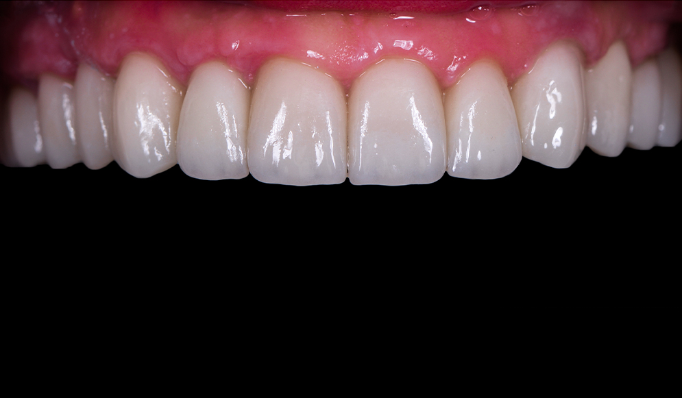 Trio-Dental-Center-After-implants02