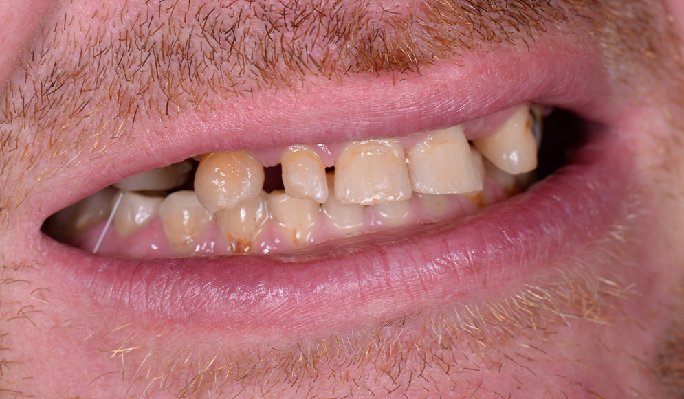 Trio-Dental-Center-Before-implants01