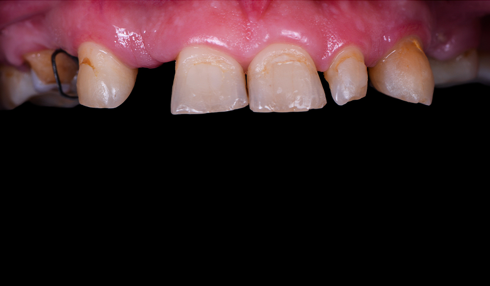 Trio-Dental-Center-Before-implants02
