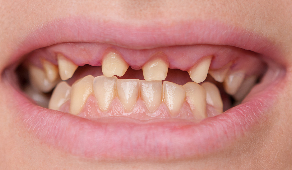 Trio-Dental-Center-Before-implants03