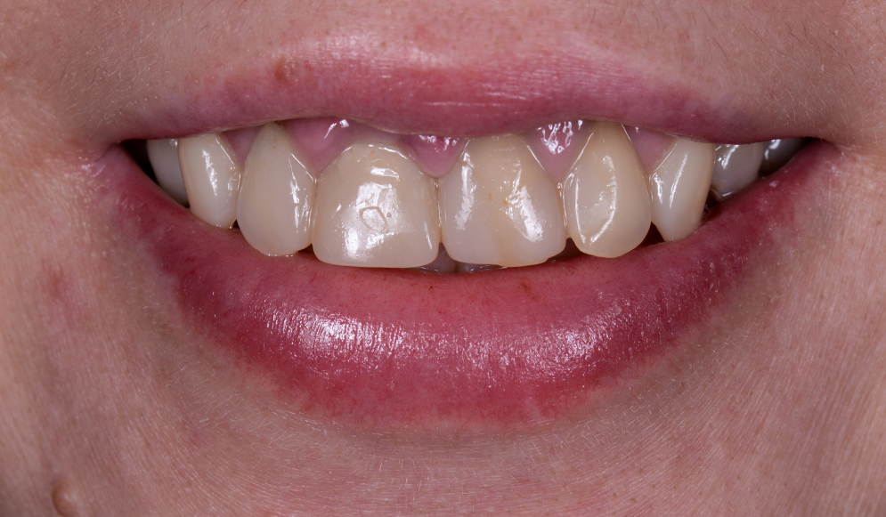 Trio-Dental-Center-Before-veneers1