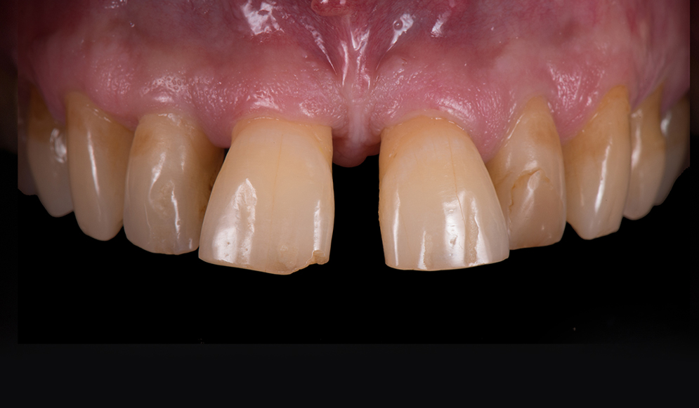 Trio-Dental-Center-Before-veneers2