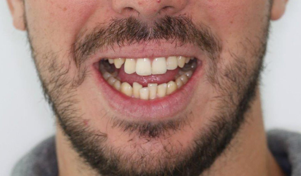 Trio-Dental-Invisalign-Before02