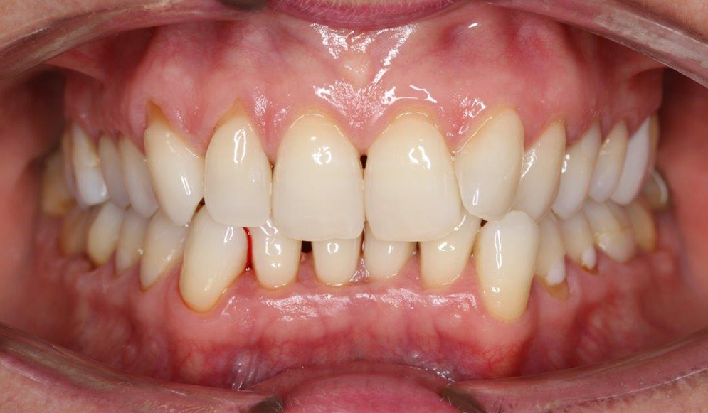 Trio-Dental-braces-Before01