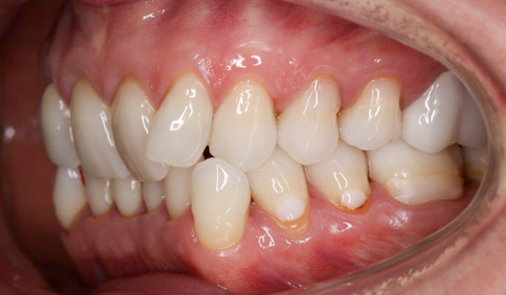 Trio-Dental-braces-Before02