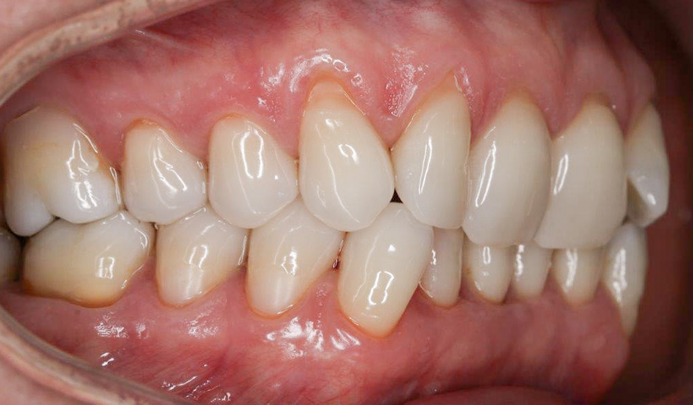 Trio-Dental-braces-Before03