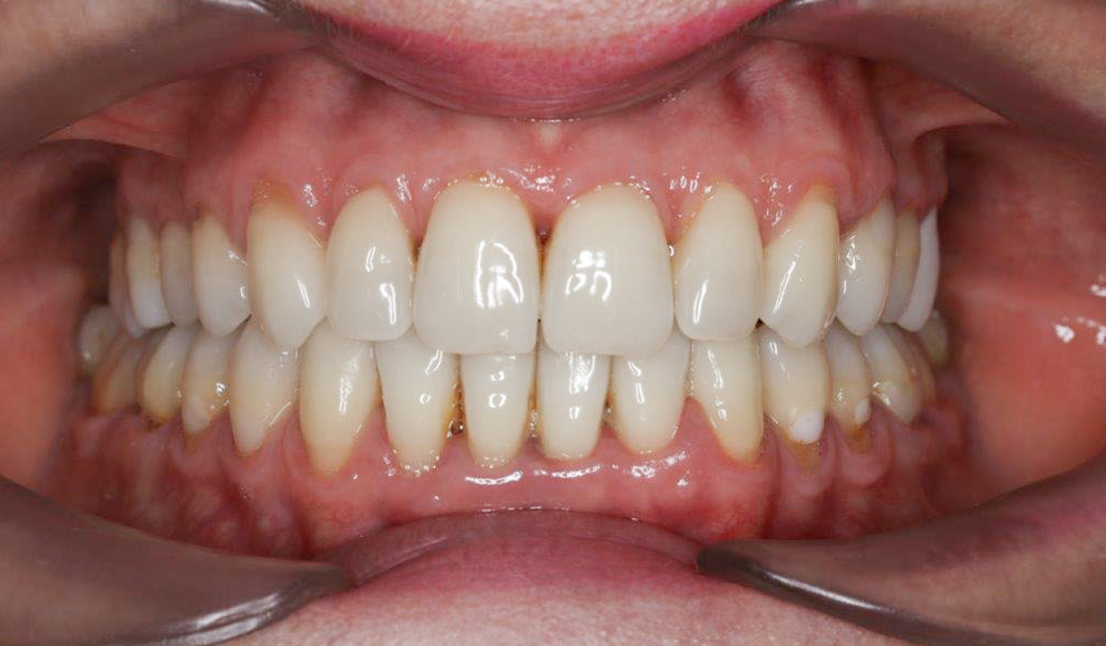 Trio-Dental-braces-after01