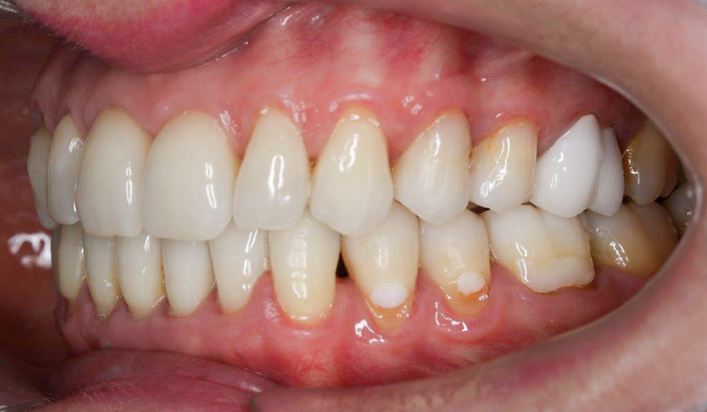 Trio-Dental-braces-after02