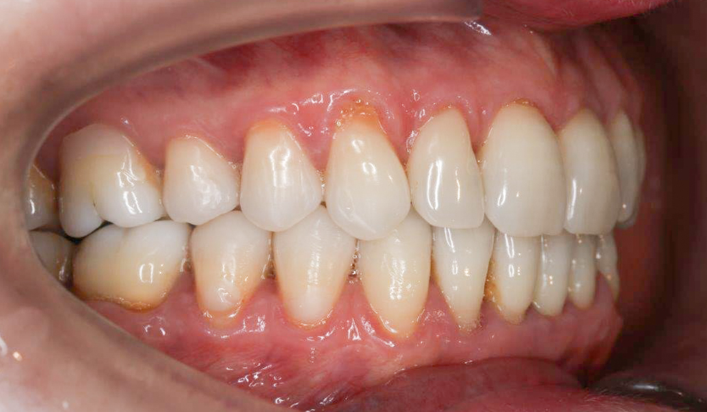 Trio-Dental-braces-after03