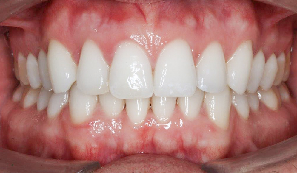 Trio-Dental-Lingual-braces-After01