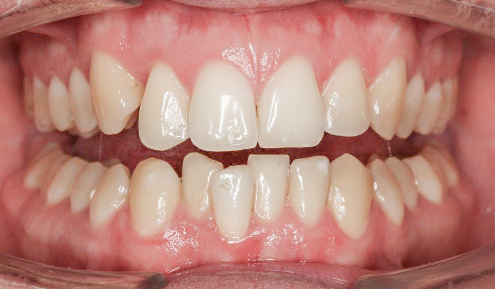 Trio-Dental-Lingual-braces-Before01